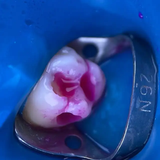 Avant/Après orthodontie